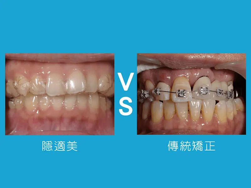 我適合隱適美嗎?與傳統矯正的差別?4類人適合隱適美 我適合隱適美嗎?與傳統矯正的差別?4類人適合隱適美