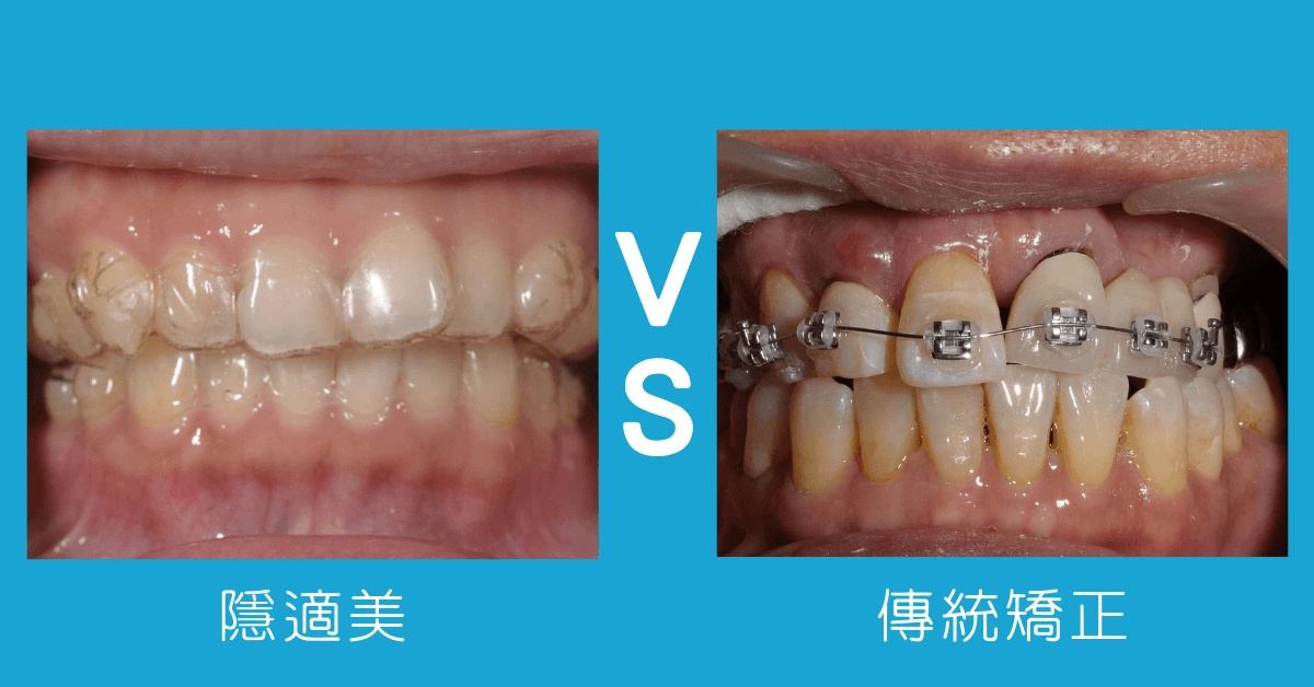 我適合隱適美嗎?與傳統矯正的差別?4類人適合隱適美 我適合隱適美嗎?與傳統矯正的差別?4類人適合隱適美