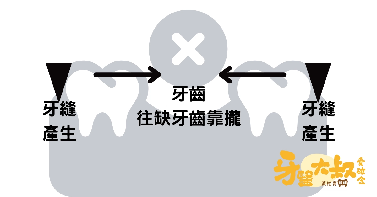 缺牙不補會怎樣?植牙的好處與限制 缺牙不補會怎樣?植牙的好處與限制