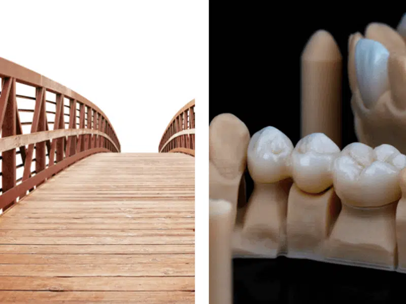 缺牙怎麼補:牙橋、植牙、假牙比較 缺牙怎麼補:牙橋、植牙、假牙比較