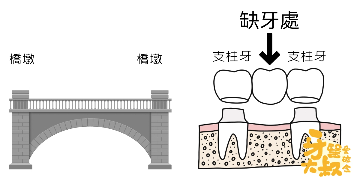 缺牙怎麼補:牙橋、植牙、假牙比較 缺牙怎麼補:牙橋、植牙、假牙比較