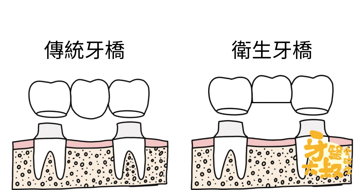 缺牙怎麼補:牙橋、植牙、假牙比較 缺牙怎麼補:牙橋、植牙、假牙比較