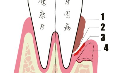 牙齦流血？小心牙周病五大徵兆