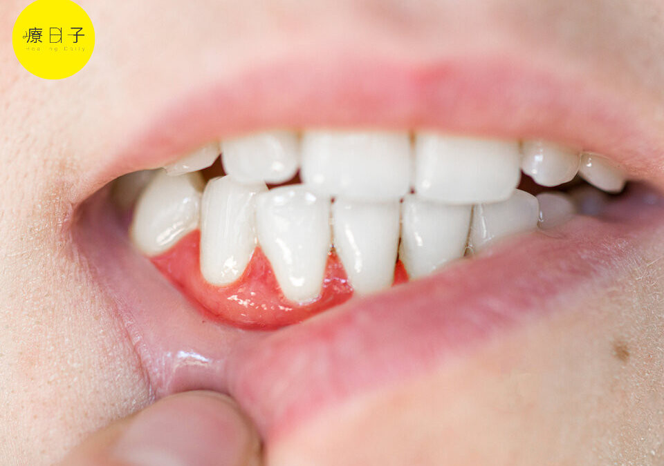 牙齦萎縮、出血，牙周病治療方式有哪些？醫：這樣做避免復發！