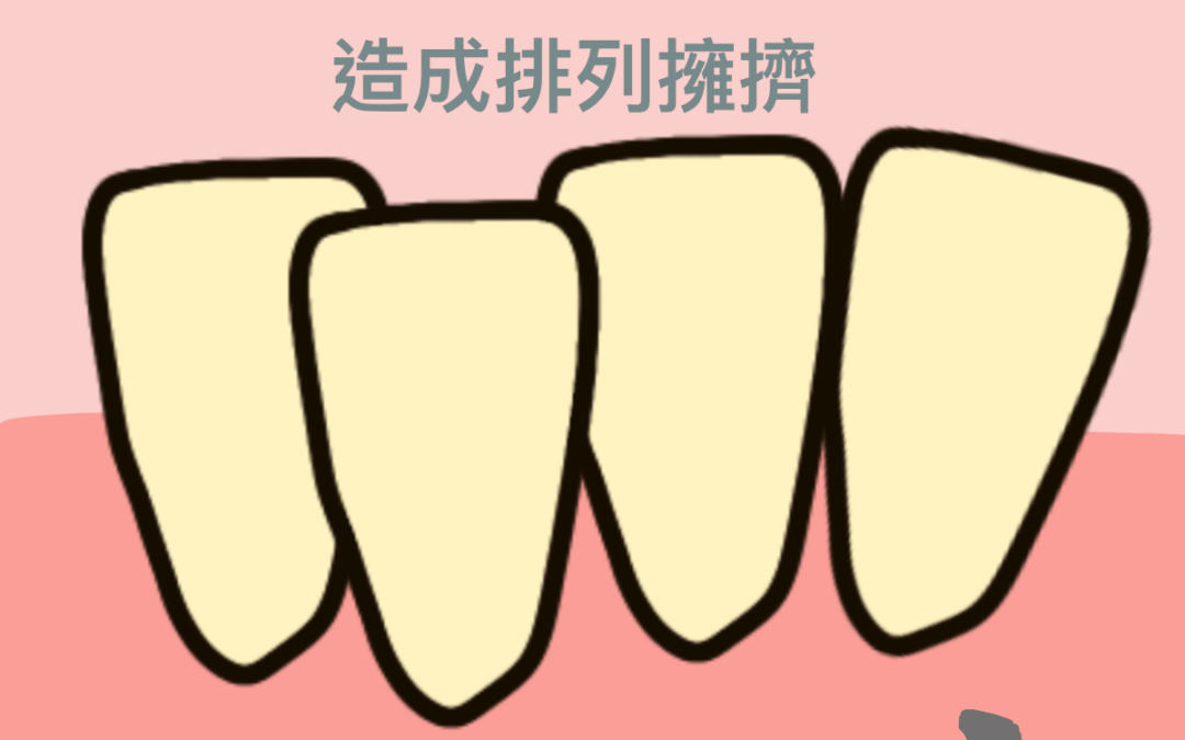 為什麼矯正醫師要修我的牙齒？牙齒間珐瑯質的寬度調整