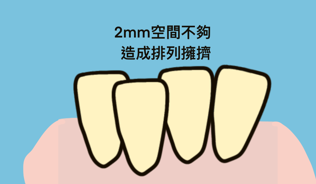 為什麼矯正醫師要修我的牙齒？IPR-牙齒間珐瑯質的寬度調整