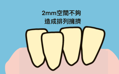 為什麼矯正醫師要修我的牙齒？IPR-牙齒間珐瑯質的寬度調整